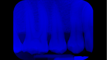 jaipicom_teeth-xray.png GrayscaleBlue