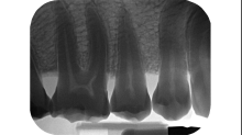 jaipicom_teeth-xray.png GrayscaleInvert