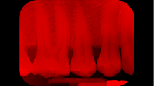 jaipicom_teeth-xray.png GrayscaleRed